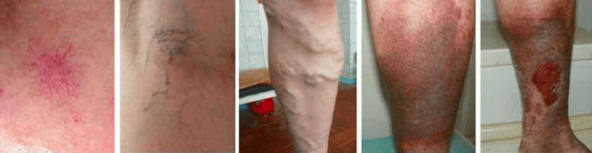 Varikozu vēnu posmi uz kājām