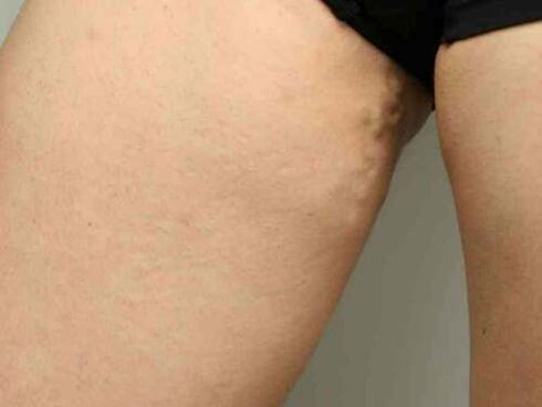 iegurņa varikozas vēnas grūtniecības laikā